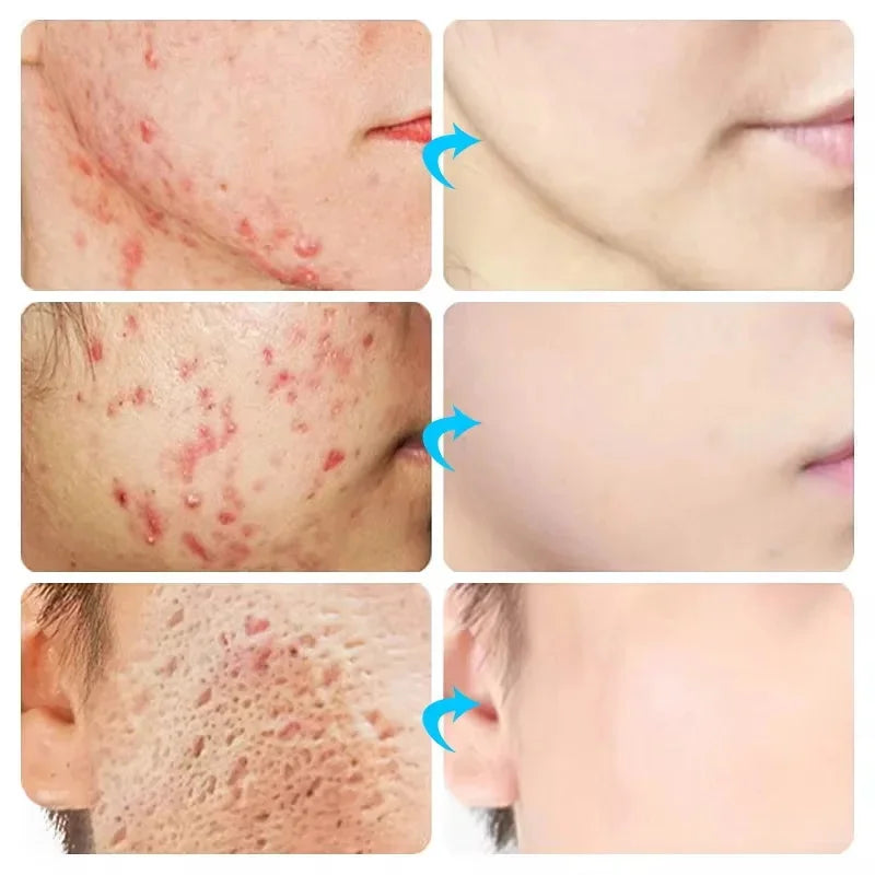 Clear Skin Renewal Acne Cream – Pore Refining, Oil Control & Spot Fading