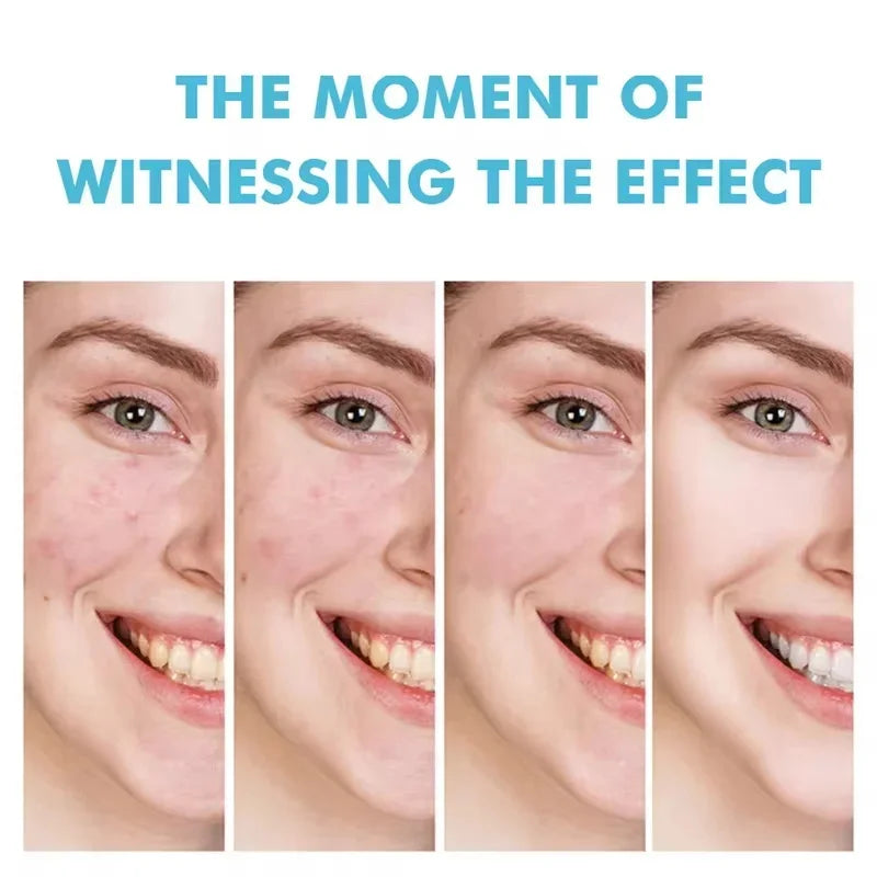 Clear Skin Renewal Acne Cream – Pore Refining, Oil Control & Spot Fading