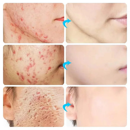 Clear Skin Renewal Acne Cream – Pore Refining, Oil Control & Spot Fading