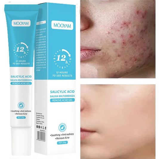 Clear Skin Renewal Acne Cream – Pore Refining, Oil Control & Spot Fading