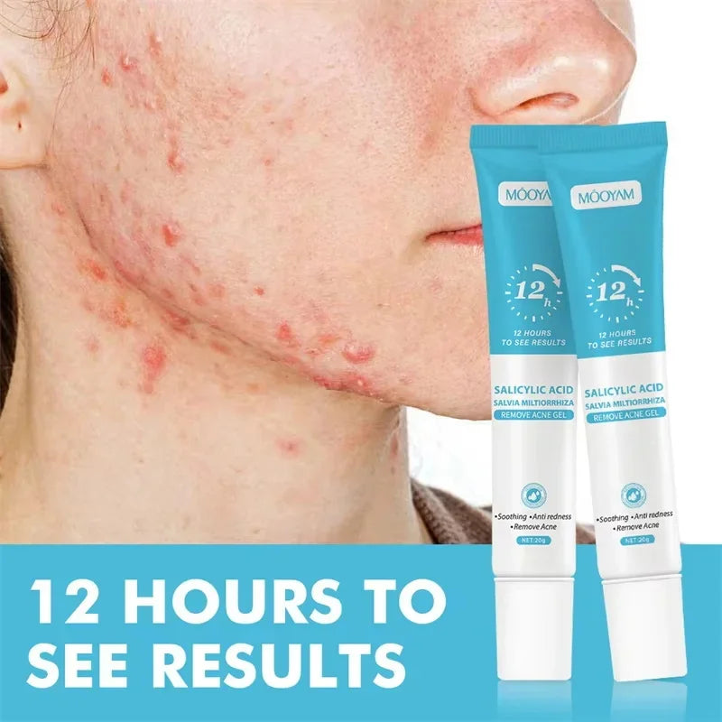 Clear Skin Renewal Acne Cream – Pore Refining, Oil Control & Spot Fading
