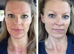 Bio Collagen Facial Mask – Lift, Hydrate & Glow